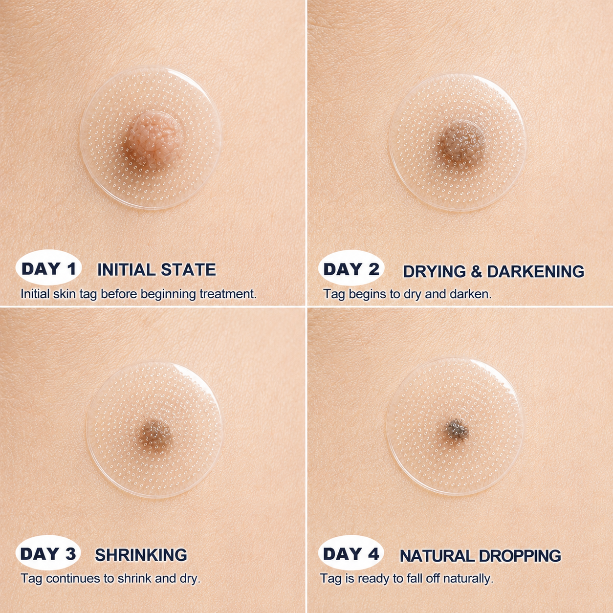 👩‍⚕️🏆 𝐎𝐟𝐟𝐢𝐜𝐢𝐚𝐥 𝐒𝐭𝐨𝐫𝐞 | GFOUK® 🌿Botanical Microneedle Hydrocolloid Patch (𝐅𝐨𝐫 𝐒𝐤𝐢𝐧 𝐓𝐚𝐠𝐬, 𝐒𝐦𝐚𝐥𝐥 𝐒𝐤𝐢𝐧 𝐆𝐫𝐨𝐰𝐭𝐡𝐬, 𝐖𝐚𝐫𝐭𝐬, 𝐌𝐨𝐥𝐞𝐬, 𝐀𝐠𝐞 𝐒𝐩𝐨𝐭𝐬 & 𝐏𝐢𝐠𝐦𝐞𝐧𝐭𝐚𝐭𝐢𝐨𝐧 𝐂𝐨𝐧𝐜𝐞𝐫𝐧𝐬)
