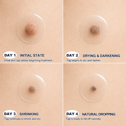 👩‍⚕️🏆 𝐎𝐟𝐟𝐢𝐜𝐢𝐚𝐥 𝐒𝐭𝐨𝐫𝐞 | GFOUK® 🌿Botanical Microneedle Hydrocolloid Patch (𝐅𝐨𝐫 𝐒𝐤𝐢𝐧 𝐓𝐚𝐠𝐬, 𝐒𝐦𝐚𝐥𝐥 𝐒𝐤𝐢𝐧 𝐆𝐫𝐨𝐰𝐭𝐡𝐬, 𝐖𝐚𝐫𝐭𝐬, 𝐌𝐨𝐥𝐞𝐬, 𝐀𝐠𝐞 𝐒𝐩𝐨𝐭𝐬 & 𝐏𝐢𝐠𝐦𝐞𝐧𝐭𝐚𝐭𝐢𝐨𝐧 𝐂𝐨𝐧𝐜𝐞𝐫𝐧𝐬)
