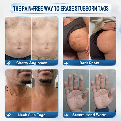 👩‍⚕️🏆 𝐎𝐟𝐟𝐢𝐜𝐢𝐚𝐥 𝐒𝐭𝐨𝐫𝐞 | GFOUK® 🌿Botanical Microneedle Hydrocolloid Patch (𝐅𝐨𝐫 𝐒𝐤𝐢𝐧 𝐓𝐚𝐠𝐬, 𝐒𝐦𝐚𝐥𝐥 𝐒𝐤𝐢𝐧 𝐆𝐫𝐨𝐰𝐭𝐡𝐬, 𝐖𝐚𝐫𝐭𝐬, 𝐌𝐨𝐥𝐞𝐬, 𝐀𝐠𝐞 𝐒𝐩𝐨𝐭𝐬 & 𝐏𝐢𝐠𝐦𝐞𝐧𝐭𝐚𝐭𝐢𝐨𝐧 𝐂𝐨𝐧𝐜𝐞𝐫𝐧𝐬)