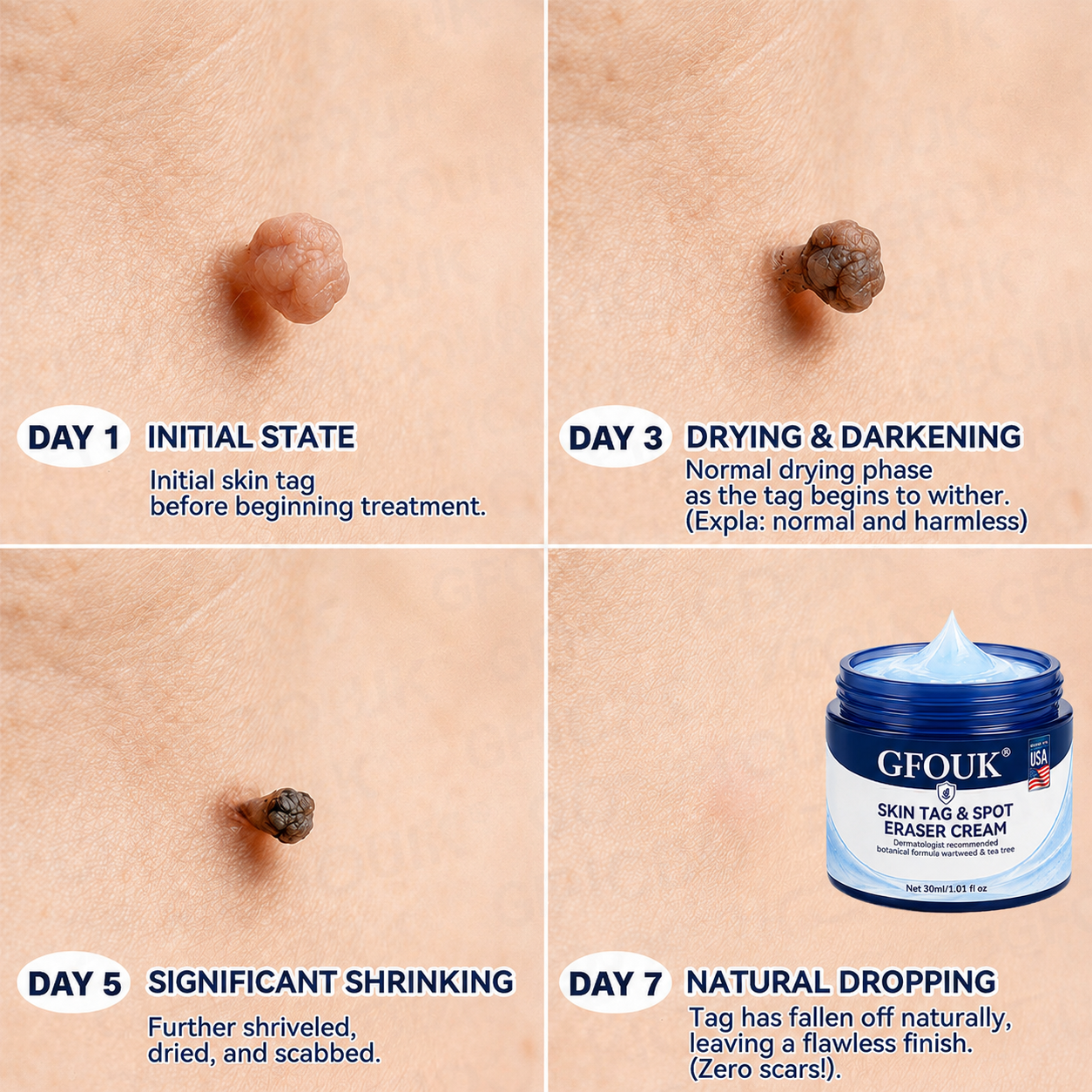 GFOUK® 7-𝐃𝐚𝐲 𝐒𝐤𝐢𝐧 𝐓𝐚𝐠 & 𝐒𝐩𝐨𝐭 𝐄𝐫𝐚𝐬𝐞𝐫 𝐂𝐫𝐞𝐚𝐦 (Zero Pain, Zero 𝐒𝐜𝐚𝐫𝐬 Formula) 🌹